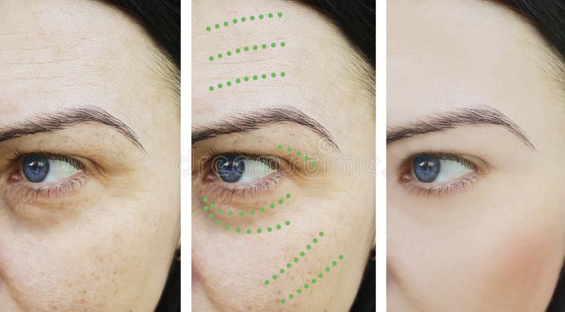 Os enrugamentos da mulher descascam a cosmetologia da diferença da terapia do rejuvenescimento da remoção da face lift antes e de