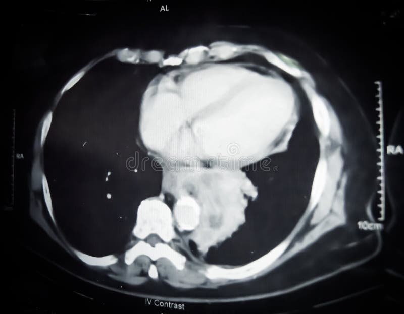Oskarpt med oväsen av en Ct-bildläsningsfilm av lungcancer i svartvitt slut upp arkivbilder Oskarpt med oväsen av en Ct-bildläsningsfilm av lungcancer i svartvitt slut upp arkivbilder