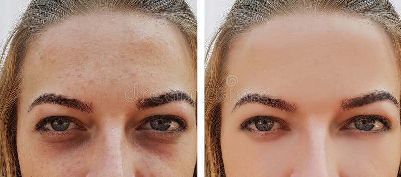Osservi la borsa della ragazza sotto gli occhi prima e dopo le procedure del cosmetico del trattamento