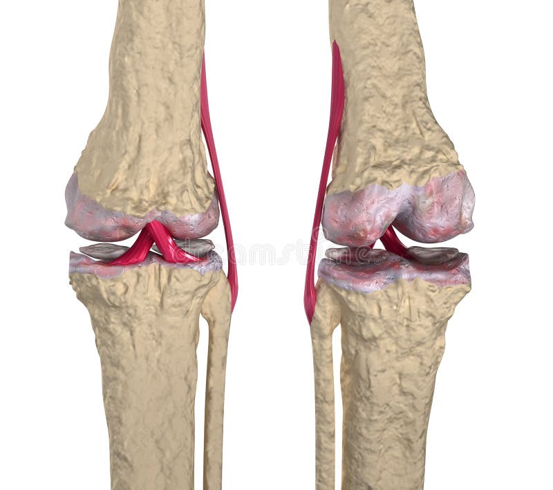 Osteoarthritis : Knee joint with ligaments and car royalty free illustration