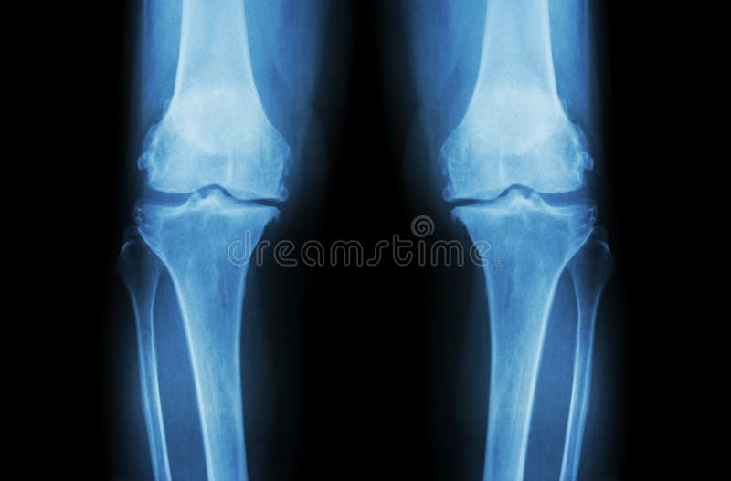 Osteoarthritis Knee ( OA Knee ). Film x-ray both knee ( front view ) show narrow joint space ( joint cartilage loss ) , osteophyte royalty free stock images Osteoarthritis Knee ( OA Knee ). Film x-ray both knee ( front view ) show narrow joint space ( joint cartilage loss ) , osteophyte royalty free stock images
