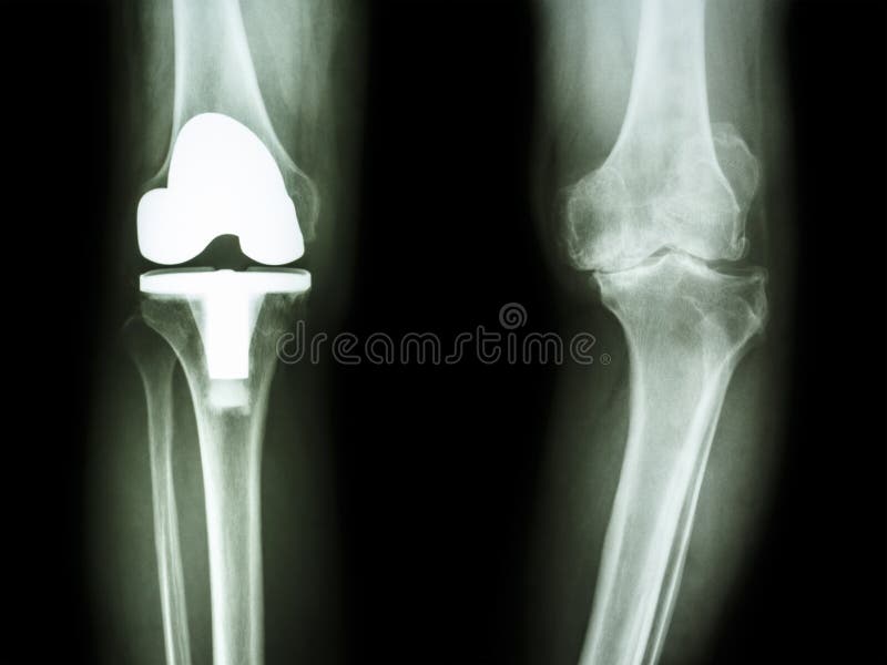 Osteoarthritis Knee ( OA Knee ) ( Film Xray Both Knee with Arthritis