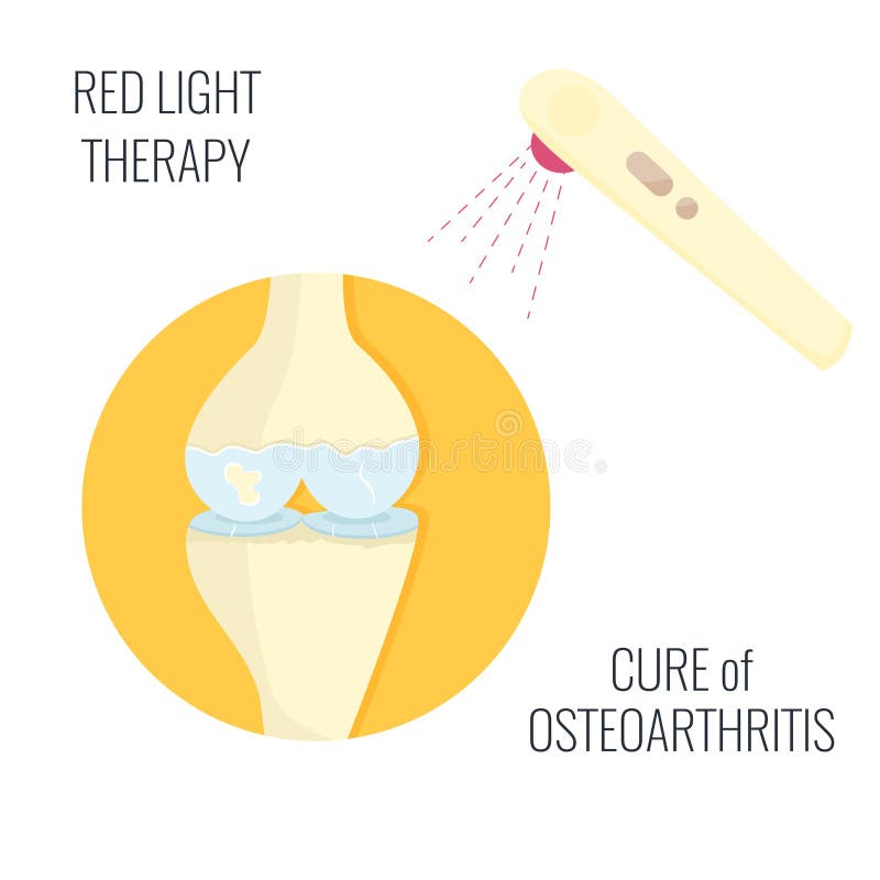 Osteoarthritis Illustration. Red Light Therapy Stock Vector