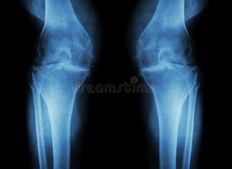 Osteoartritisknie (OA-Knie) (Filmröntgenstraal beide knie met artritis van knieverbinding: smalle Medische knie gezamenlijke ruim