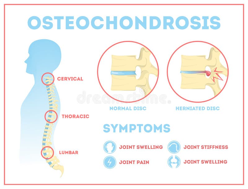 gyulladt osteochondrosis a gerinc nyaki osteochondrosisának gyógyszeres kezelése
