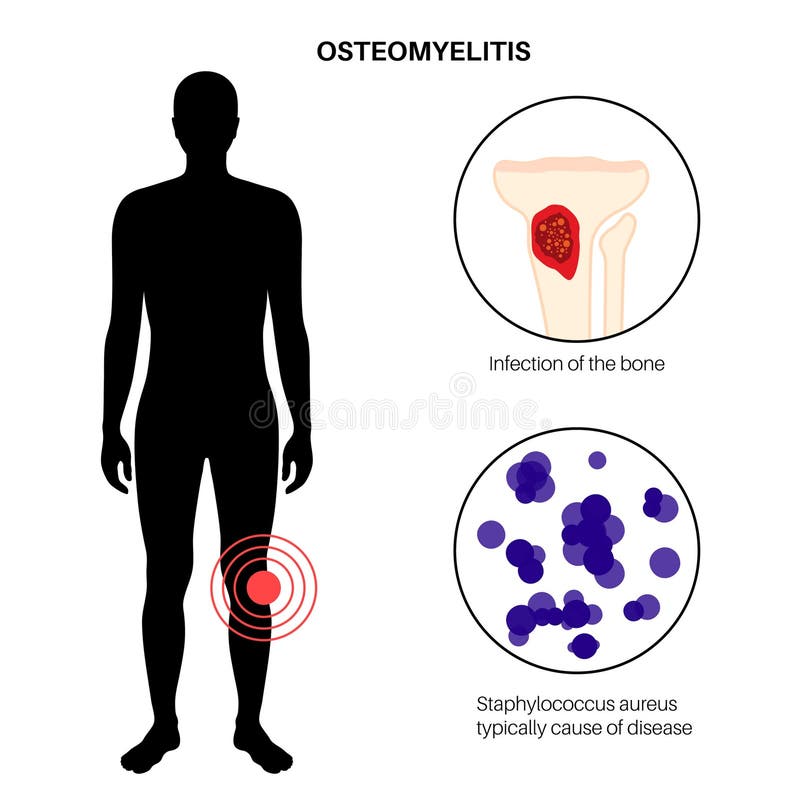 Tibia bone osteomyelitis stock vector. Illustration of osseous ...