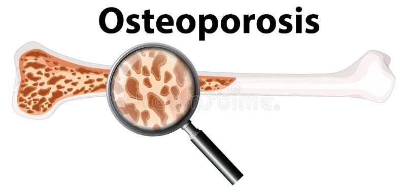 Osteoporose en Vergrootglas royalty-vrije illustratie Osteoporose en Vergrootglas royalty-vrije illustratie