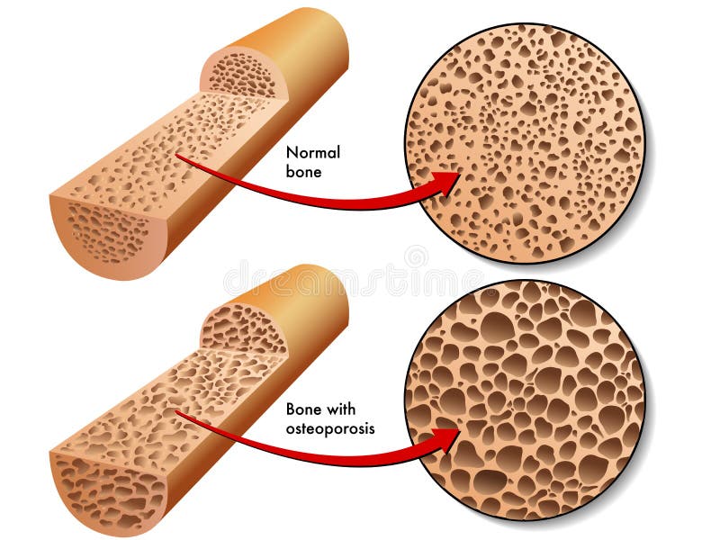 Osteoporosi Osteoporosi