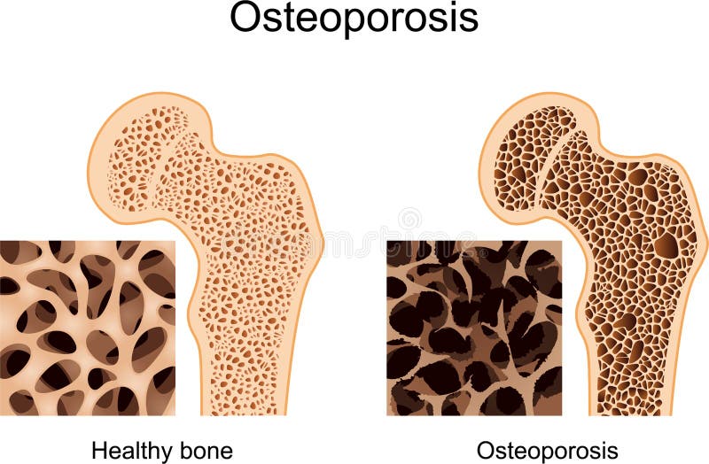 Osteoporosi femore osso microscopico.