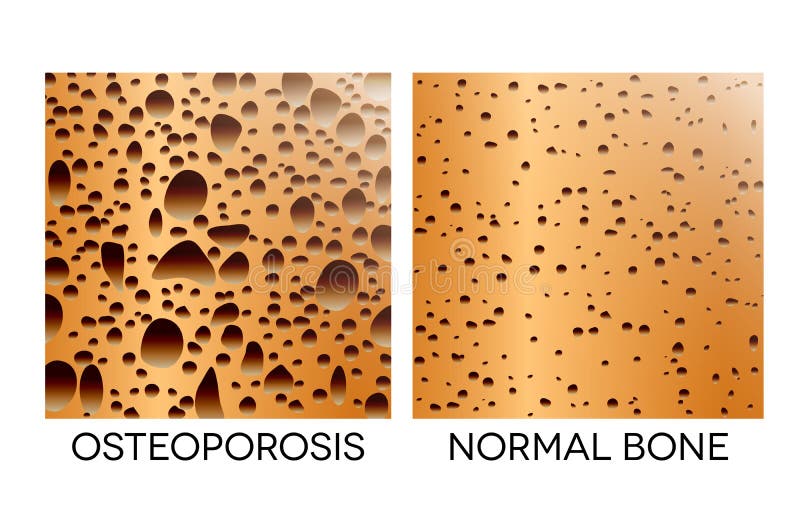 osteoporosis vektor illustrationer osteoporosis vektor illustrationer