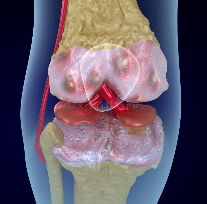 Osteoporosis of the knee joint, Medically accurate royalty free illustration Osteoporosis of the knee joint, Medically accurate royalty free illustration
