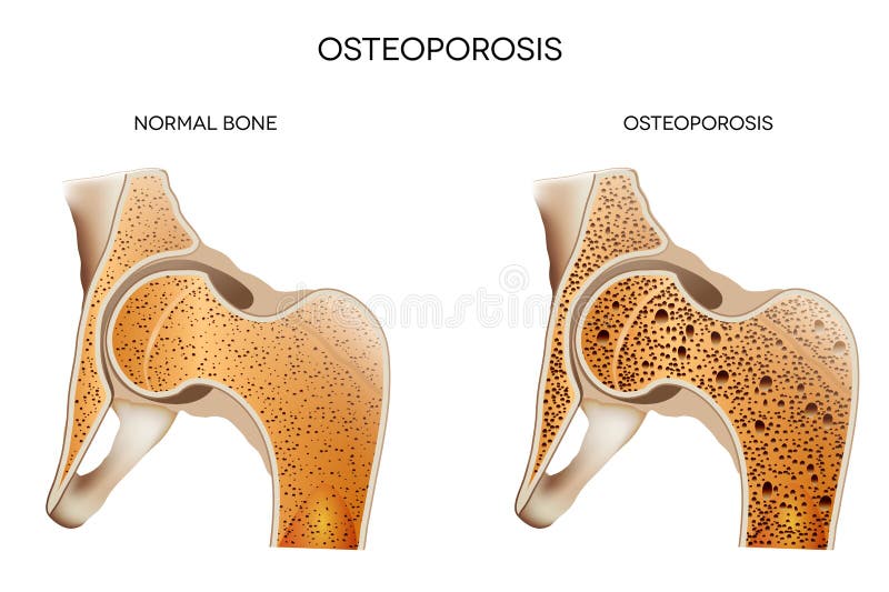 L'osteoporosi.