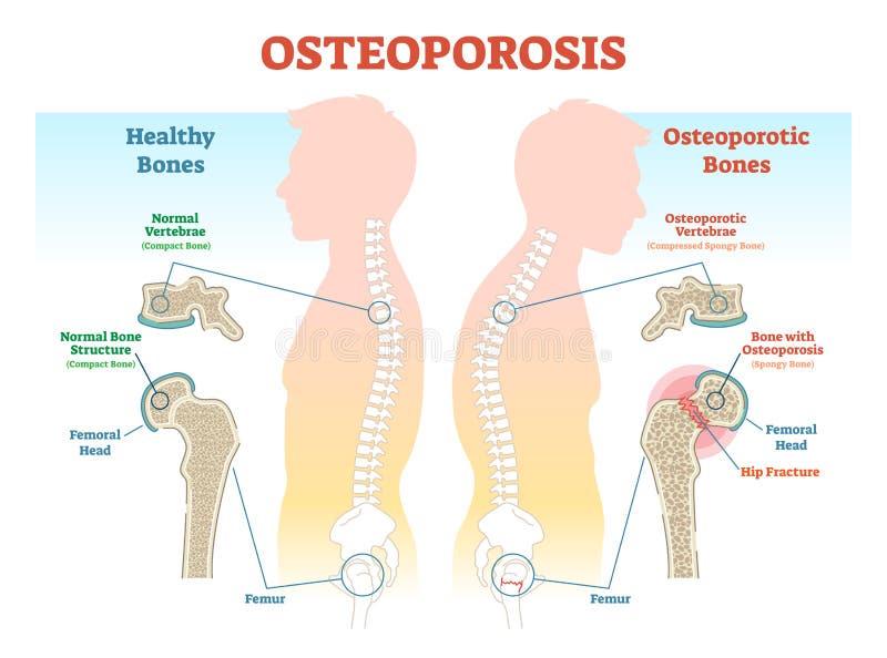 Osteoporosis przykładów wektorowy ilustracyjny diagram z kości gęstością