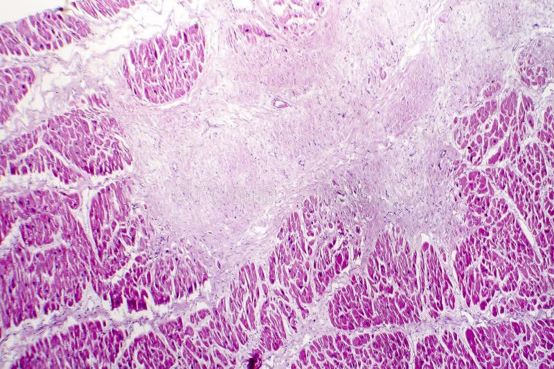 Ostry miokardialny infarction, histologia kierowa tkanka obraz stock Ostry miokardialny infarction, histologia kierowa tkanka obraz stock