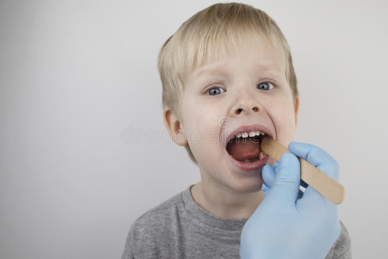 An otolaryngologist examines a child`s throat with a wooden spatula. A possible diagnosis is inflammation of the pharynx, tonsils