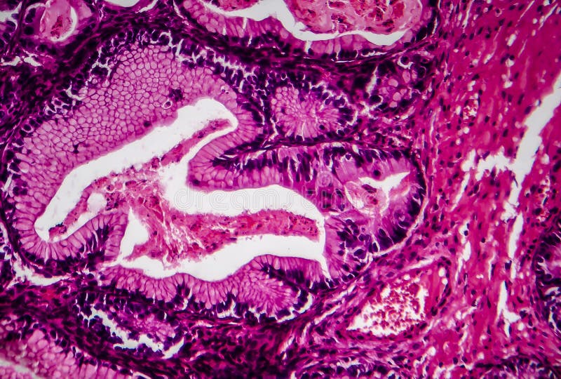 biphasic malignant pleural mesothelioma