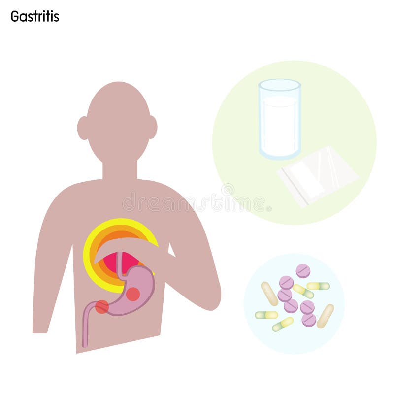 Żołądka Gastritis z leczeniem lub nieład ilustracji Żołądka Gastritis z leczeniem lub nieład ilustracji