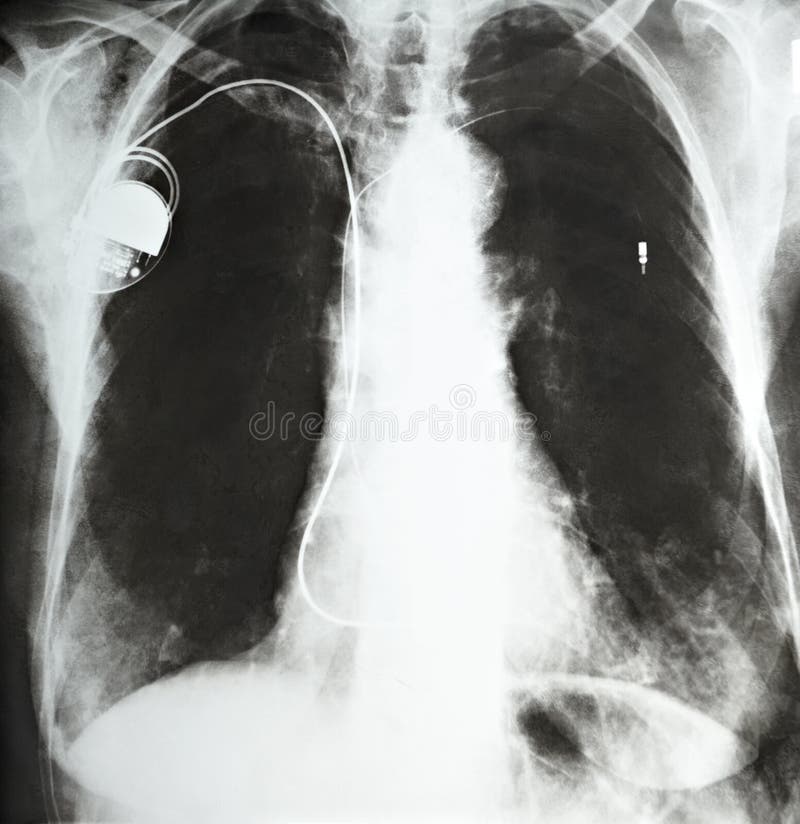 Close up of a pacemaker in a hospital