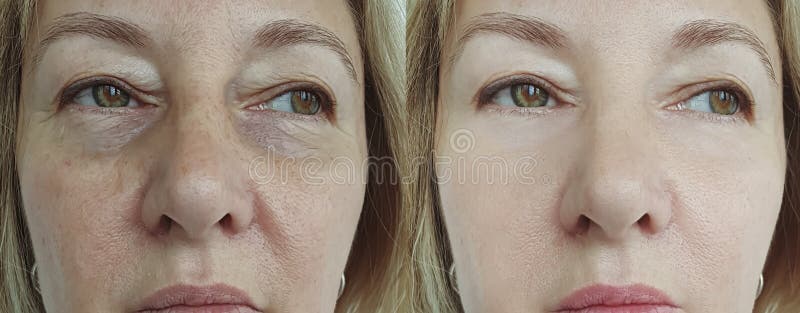 Elderly woman face wrinkles removal before and after  effect  tension revitalization lifting correction. Elderly woman face wrinkles removal before and after  effect  tension revitalization lifting correction