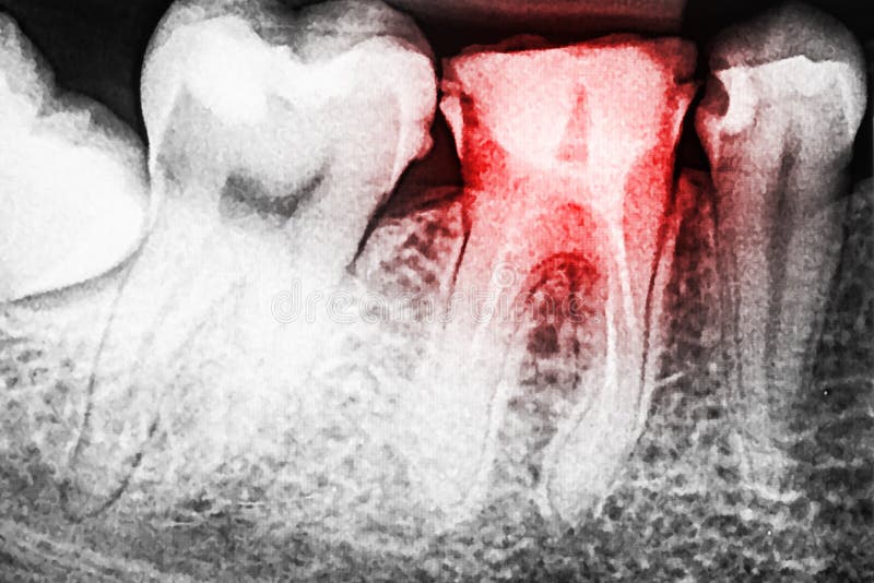 Pain of Tooth Decay on XRay Stock Photo Image of skeleton, medicine