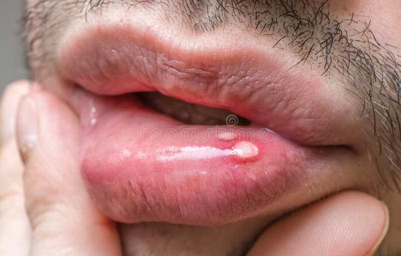 Painful aphtha ulcer on man s mouth