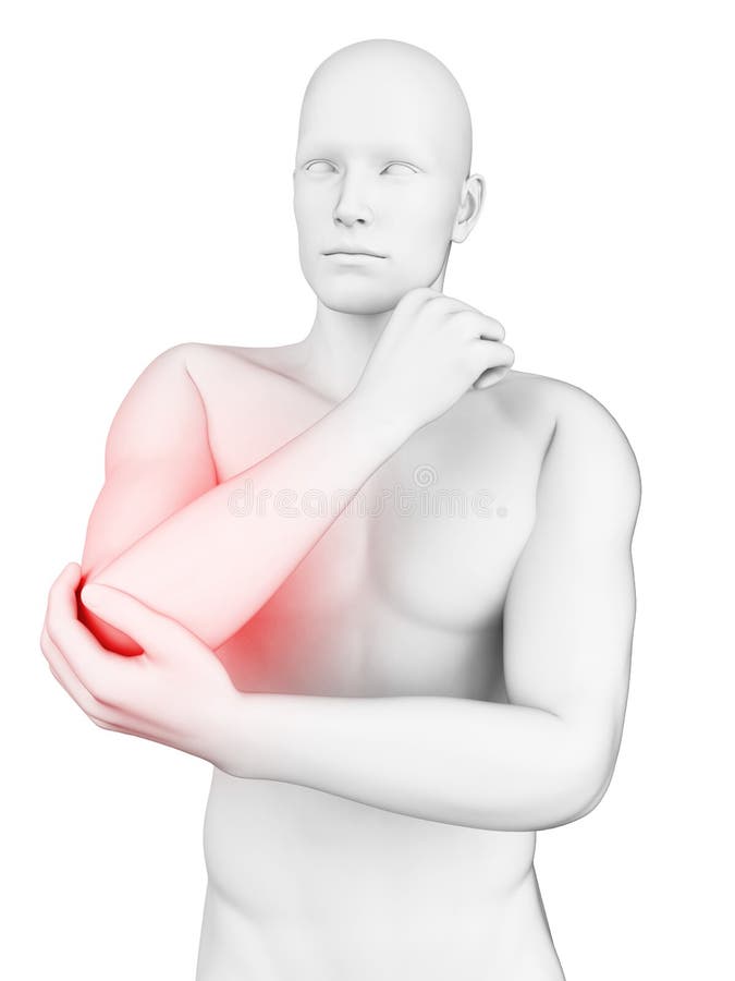 Elbow bursitis stock illustration. Illustration of elbow 19356349