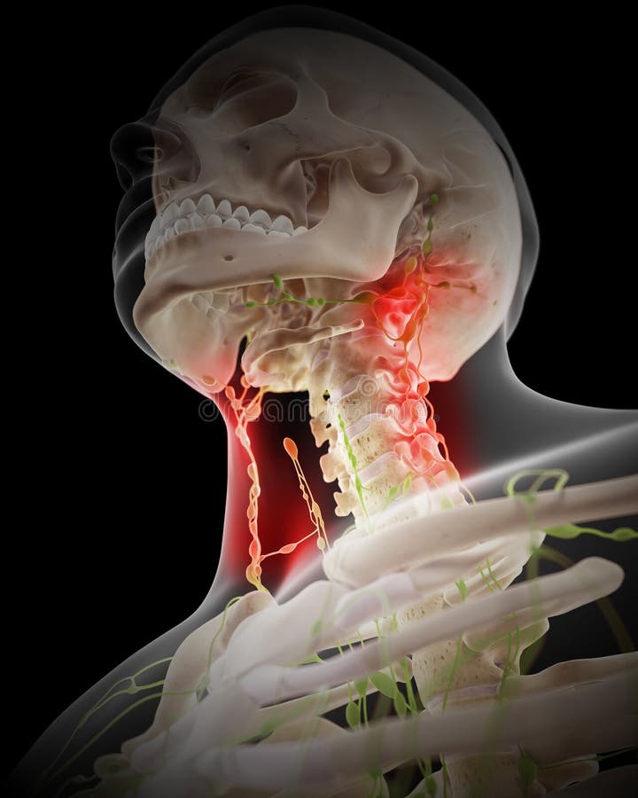 Painful Lymphatic Nodes Stock Illustration Illustration Of Lymph