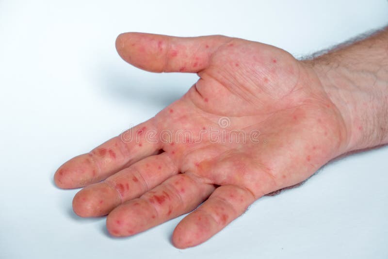 Painful Rash, Red Spots Blisters on Hand. Close Up Allergy Rash, Hands with Dermatitis and Health Problem Stock Image - Image of covid, bacterial: 231386215