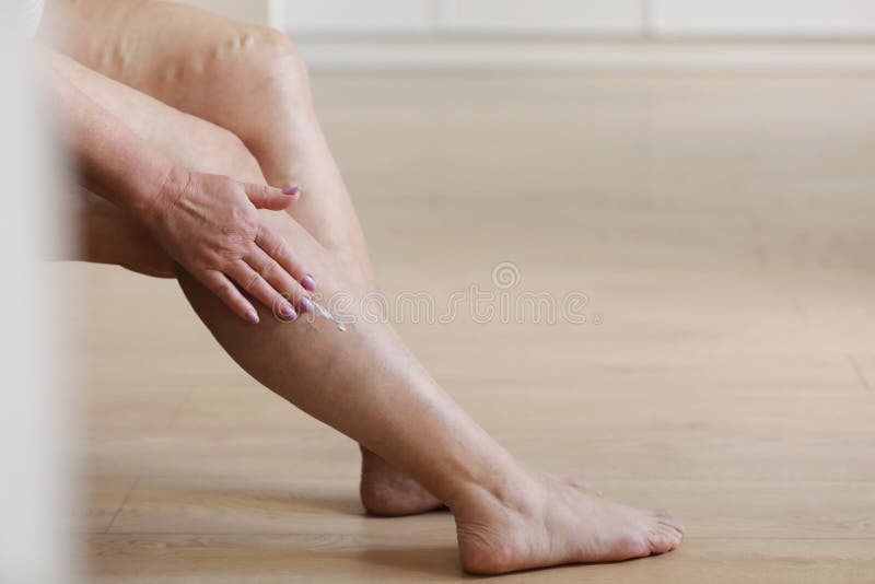 Painful Varicose and Spider Veins on Active Womans Legs, Selfhelping
