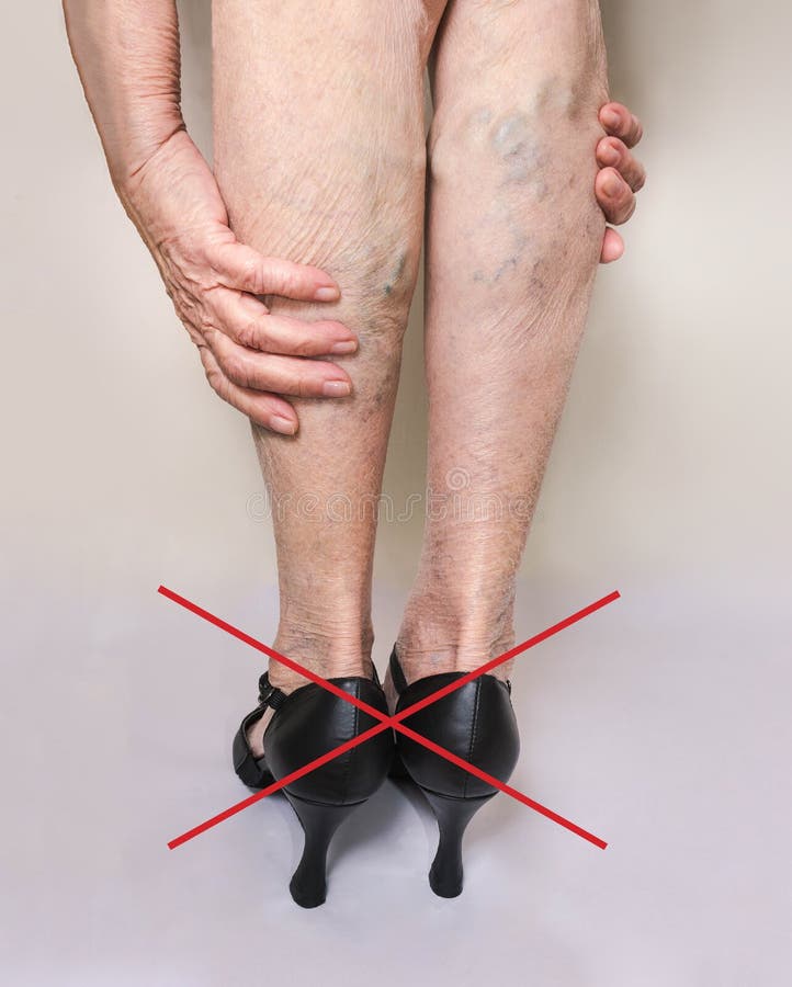 Painful Varicose Veinsspider Veins Varices On A Severely Affected Leg  Ageing Old Age Disease Aesthetic Problem Concept Stock Photo - Download  Image Now - iStock
