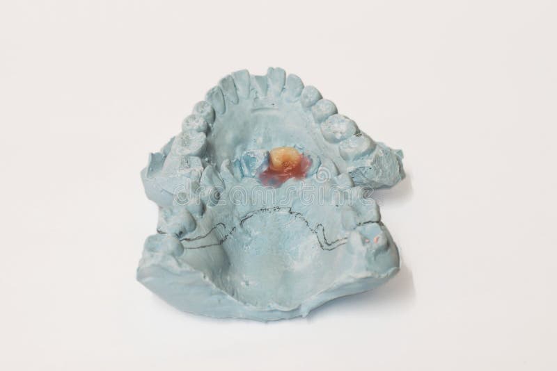 Pair of Dental Plaster Molds Stock Photo Image of metal, plaster