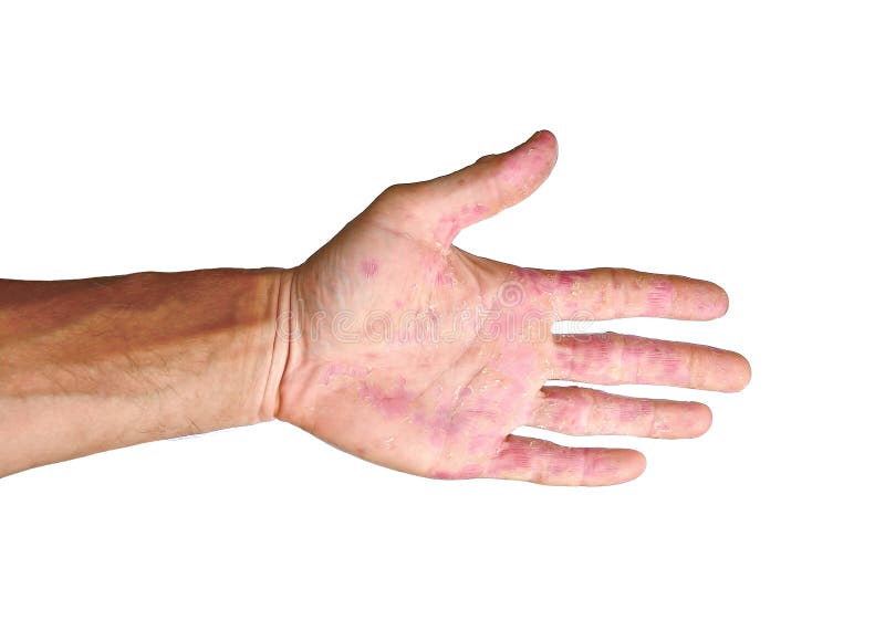 Palm Patient Erythema In Red Spots From Inflammation Isolated Stock