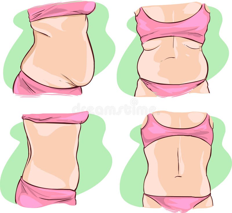 Pancia grassa prima e dopo il trattamento illustrazione vettoriale Pancia grassa prima e dopo il trattamento illustrazione vettoriale