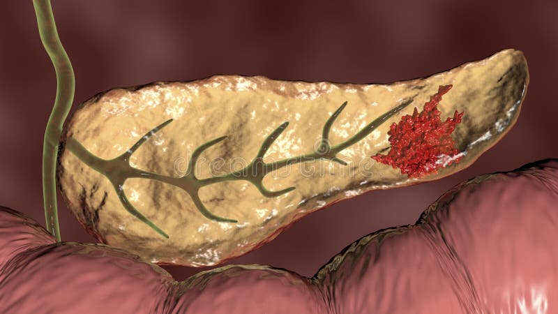 Pancreatic Cancer Malignant Tumor Of Pancreas Stock Illustration pancreatic-cancer-malignant-tumor-of-pancreas-stock-illustration
