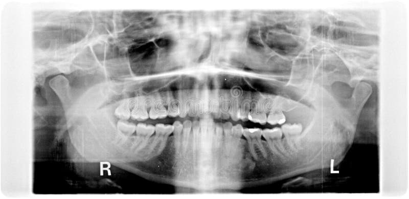 Xray panorama of damaged jaw erosion of the jaw joint TMJ in black and white, wisdom tooth is removed. Xray panorama of damaged jaw erosion of the jaw joint TMJ in black and white, wisdom tooth is removed