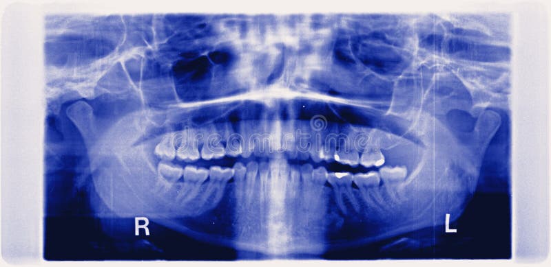 Xray panorama of damaged jaw erosion of the jaw joint TMJ in black and white, wisdom tooth is removed. Xray panorama of damaged jaw erosion of the jaw joint TMJ in black and white, wisdom tooth is removed