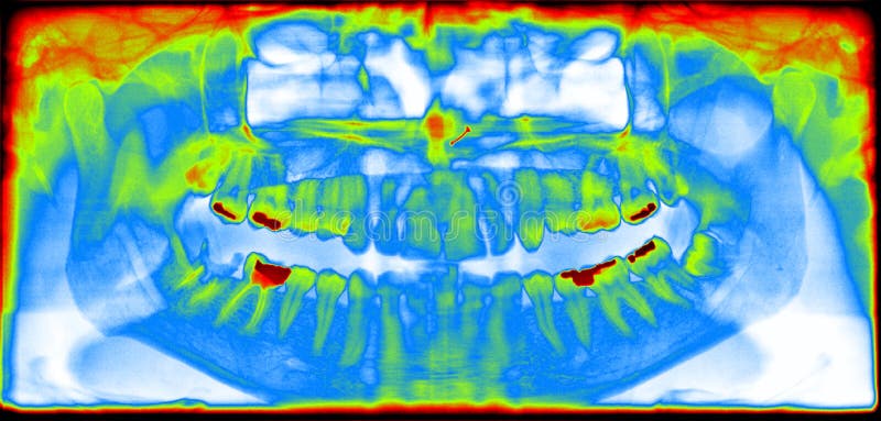 Panoramic dental x-ray