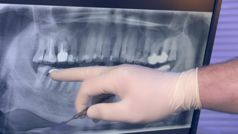 Panoramic X-ray of teeth on the monitor and the doctor`s hand in glove with the tool
