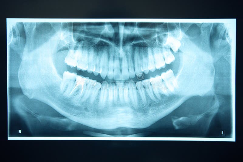 panoramic xray panoramic xray