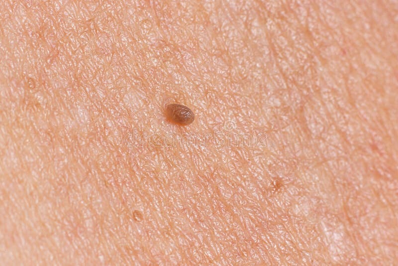 Papilloma virus e tumore al seno - Exemple de pseudoparaziți