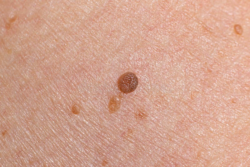 benign nevus