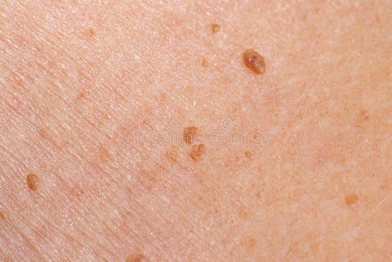 papilloma skin benign