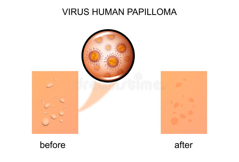 Papiloma del ser humano del virus
