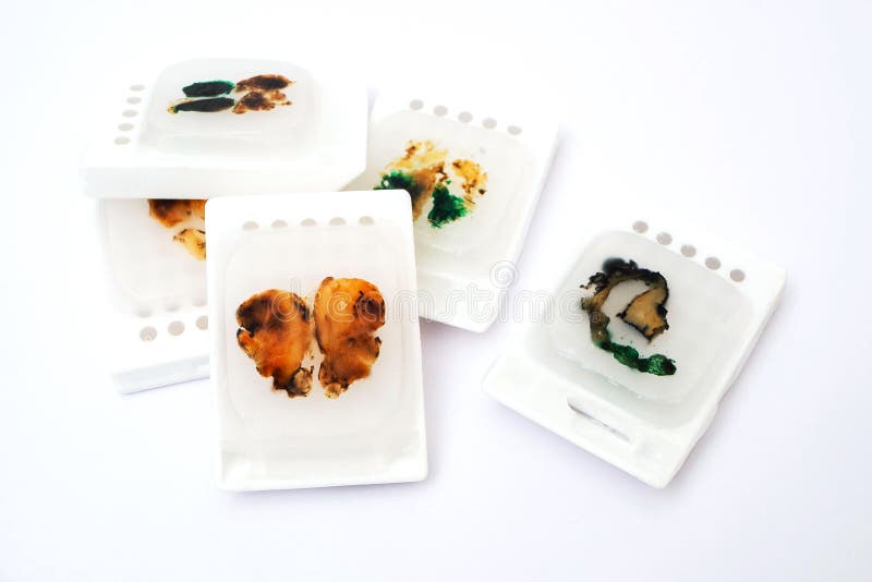 Paraffin Blocks With Cancer Samples, Samples For Histological Examination Of The Tumor Stock