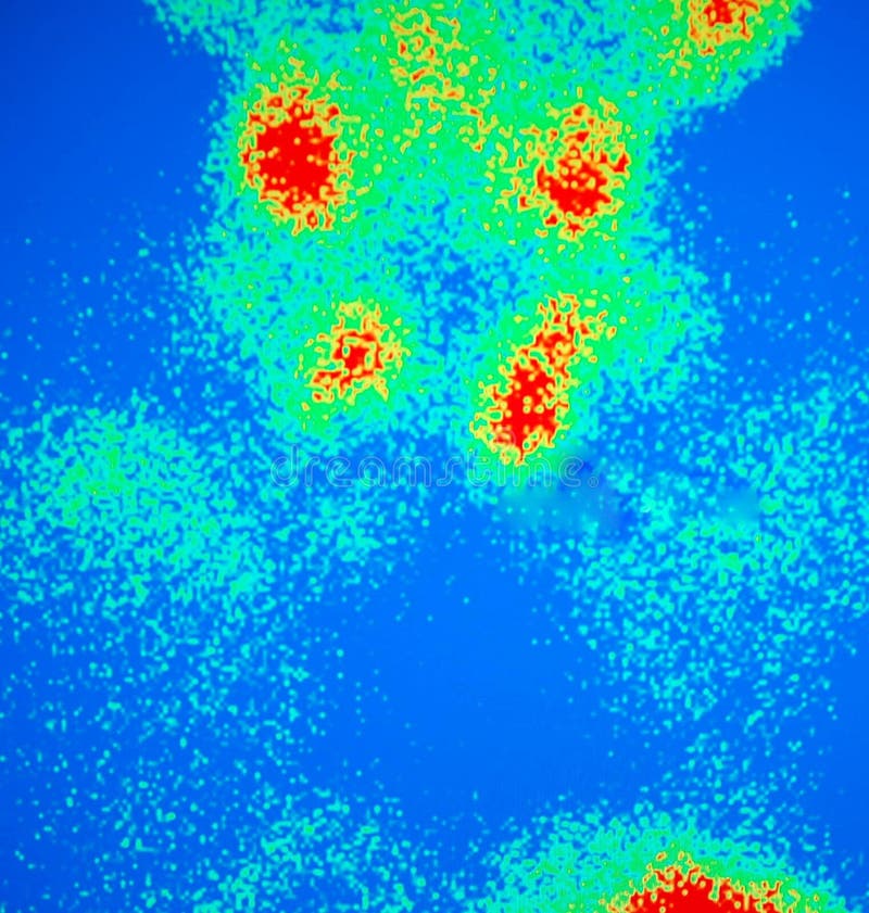 Parathyroid adenoma nuclear scan