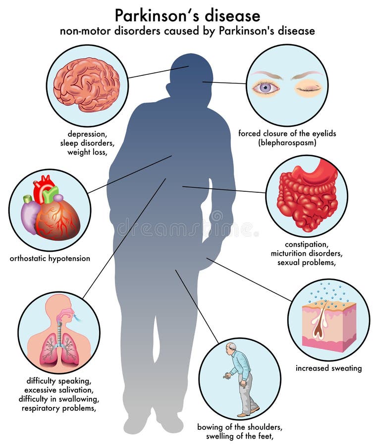 Parkinson choroba ilustracji Parkinson choroba ilustracji