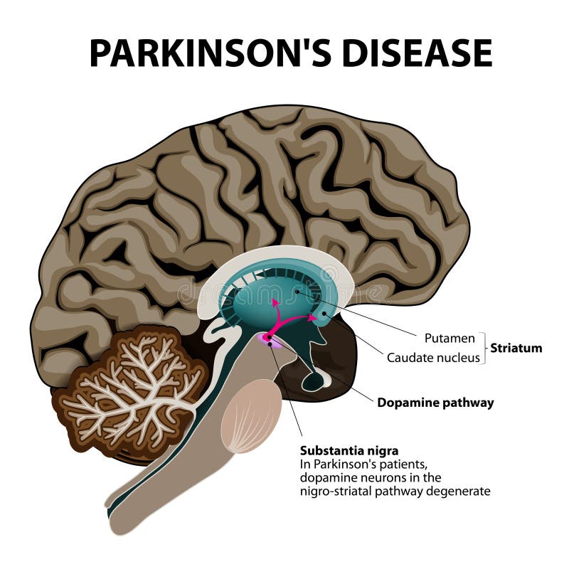 Parkinsons choroba royalty ilustracja Parkinsons choroba royalty ilustracja
