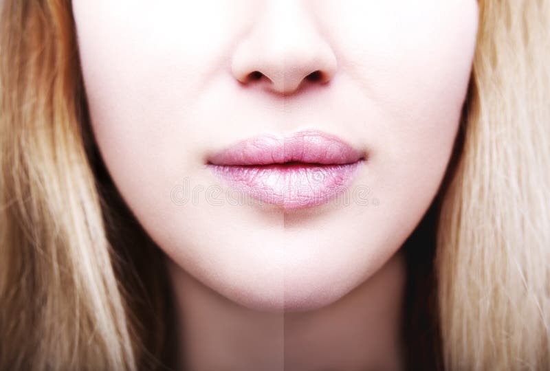 Part of face, young woman close up. plump lips after filler injection.