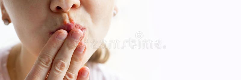 Parte inferior de la cara de la mujer con burbujas rojas de herpes virus en sus labios, se esconde con su palma en fondo blanco, Z imágenes de archivo libres de regalías Parte inferior de la cara de la mujer con burbujas rojas de herpes virus en sus labios, se esconde con su palma en fondo blanco, Z imágenes de archivo libres de regalías
