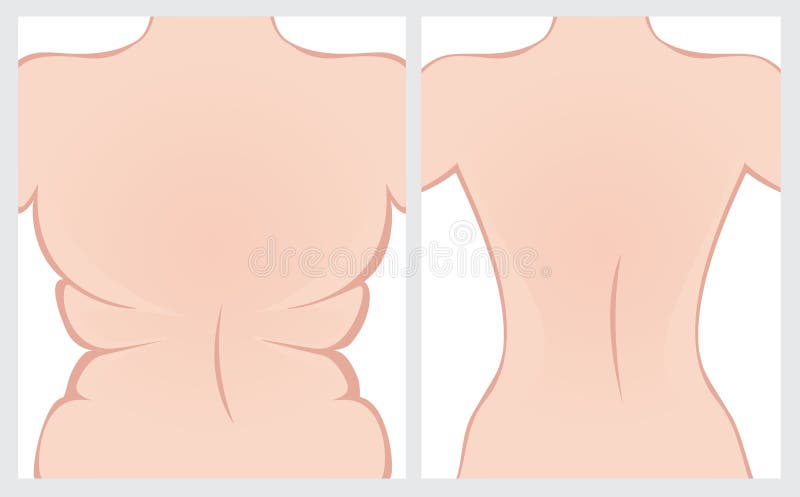 Parte posterior de la grasa antes y después del tratamiento stock de ilustración Parte posterior de la grasa antes y después del tratamiento stock de ilustración